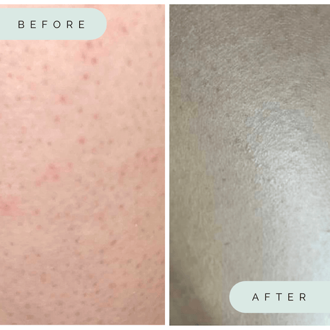 Before and After Keratosis Pilaris Using WIldpier Deep Exfoliation Glove