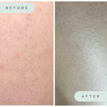 Load image into Gallery viewer, Before and After Keratosis Pilaris Using Wildpier Deep Exfoliation Glove
