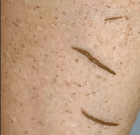 Skin Peeling - Arm